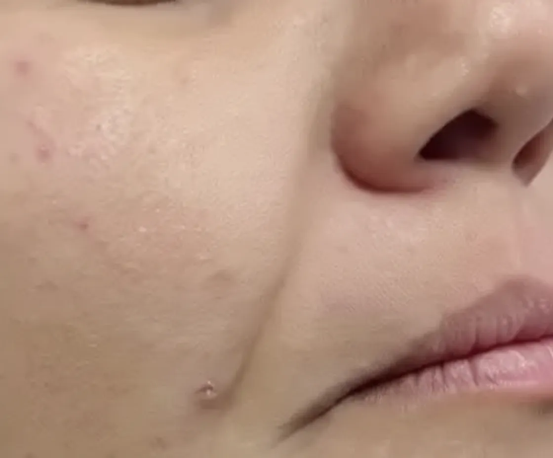 Cheek and nasolabial fold after Fotona 4D