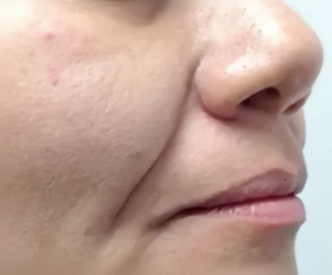 Cheek and nasolabial fold before Fotona 4D