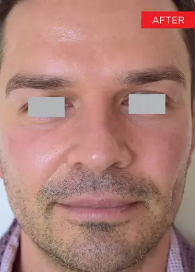 Man's face after Fotona 4D