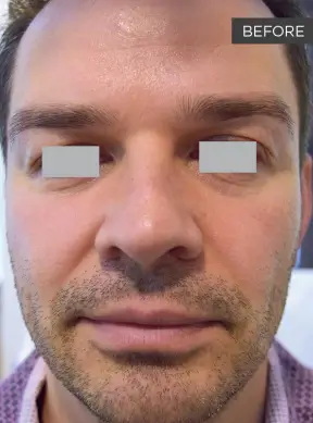 Man's face before Fotona 4D