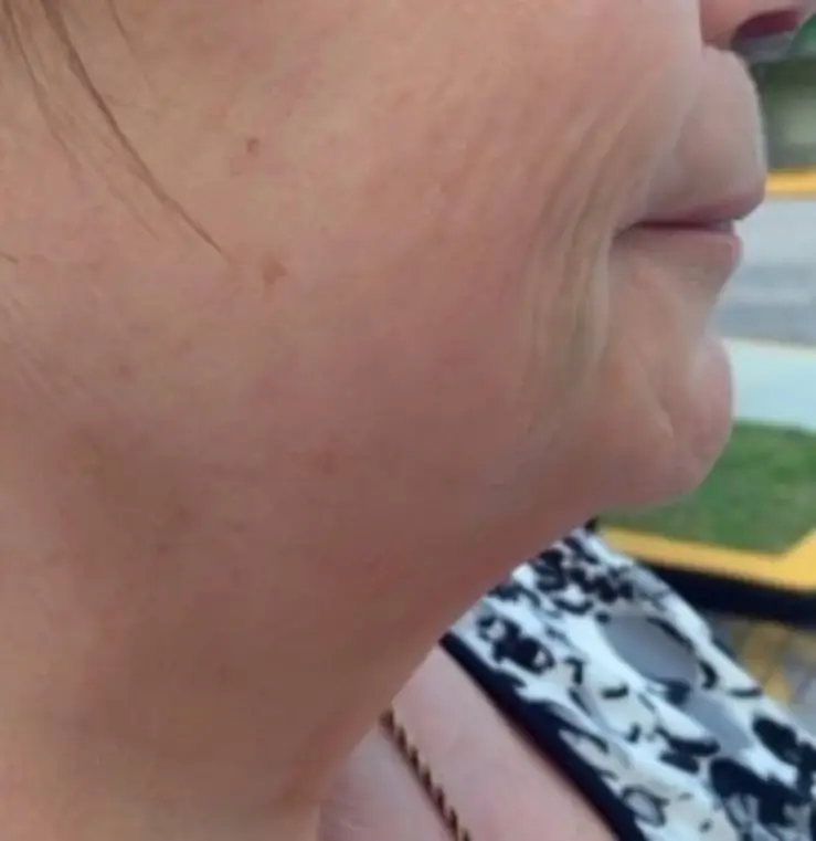 Jawline and neck after Fotona 4D