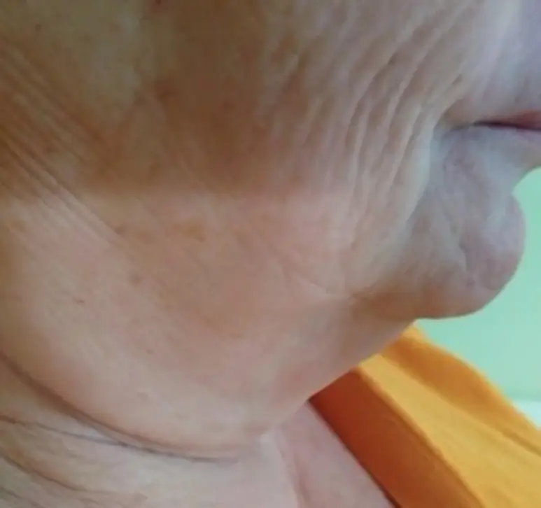 Jawline and neck before Fotona 4D